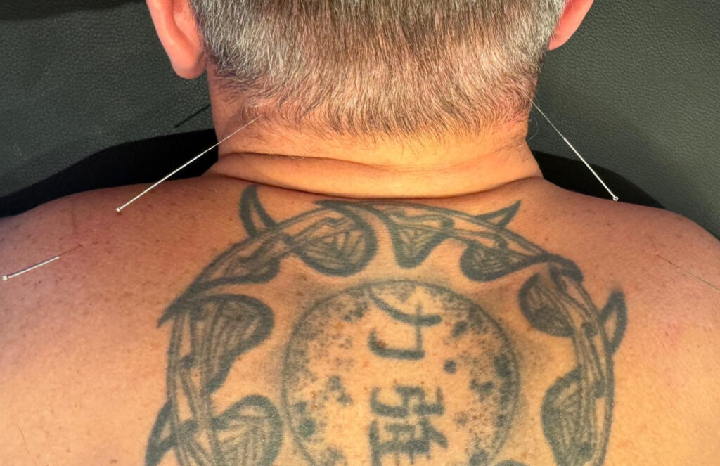 A person receives dry needling on their back, revealing a large tattoo surrounded by silver needles.